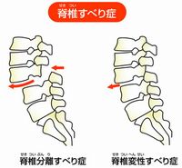 すべり症